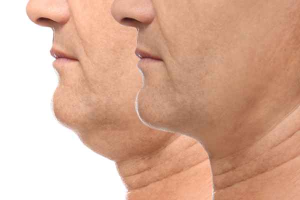 HIFU - Breakthrough in Anti - ageing 2 hifu results Beccles