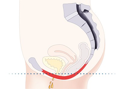 Pelvic-Floor Muscle Repair 5 Pelvic floor muscles Beccles