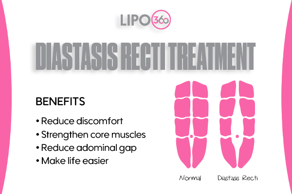 Revolutionising Muscle Repair: The Power of LIPO360 Body Sculpt Post-Injury 5 diastasis recti treatment Beccles