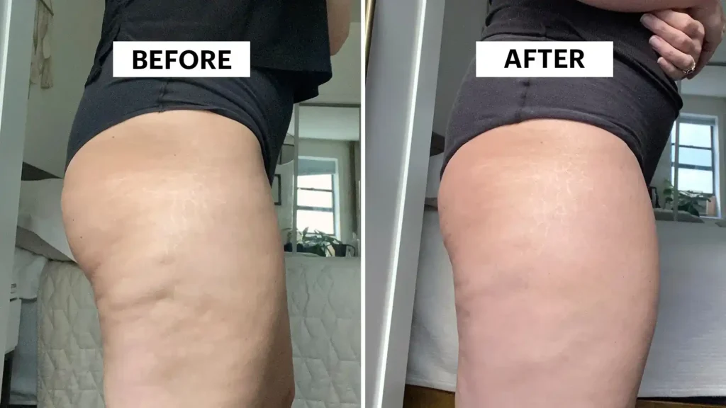 Sculpting Your Bum: Can Toning Exercises Really Reduce Cellulite? 1 Do Toning Exercise Beccles Really Tackle Cellulite?