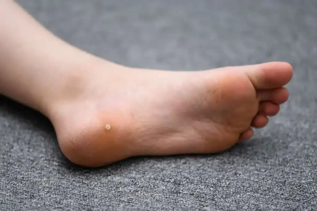 Cryotherapy For Warts And Also Verrucas 2 Image of verruca on the bottom of the foot that able to be treated with Cryotherapy Beccles