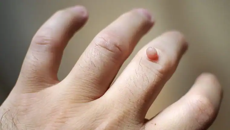 Cryotherapy For Warts And Also Verrucas 1 Image of blemish that Cryotherapy Beccles can remove with Lipo 360.
