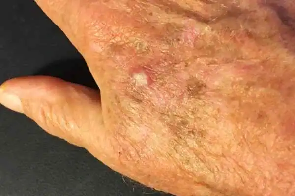 Image of Actinic keratoses Beccles on a person hand