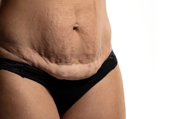 The science behind skin tightening Beccles picture of a woman's sagging skin on the stomach